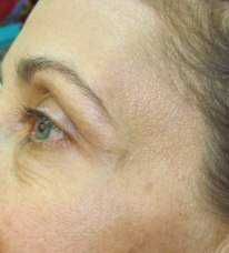 Botox for crow's feet after 383411