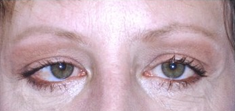 Brow Lift with lower blepharoplasty (lower eyelids) after 143523