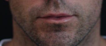 Male lip augmentation after 393232