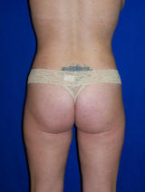 Liposuction of the flanks and medial thighs after 130054