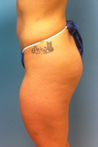 Gluteal Implants before 539055