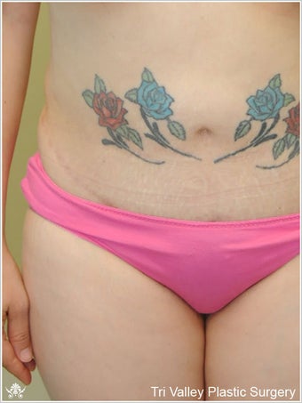 Liposuction before 420936