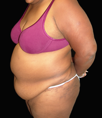 Tummy Liposuction before 230743