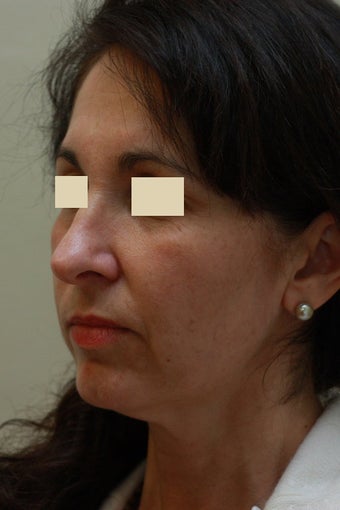 Facelift before 102547