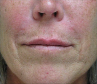 Juvederm to the upper lip after 77461