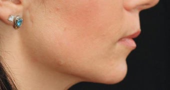 Lip Augmentation after 399251