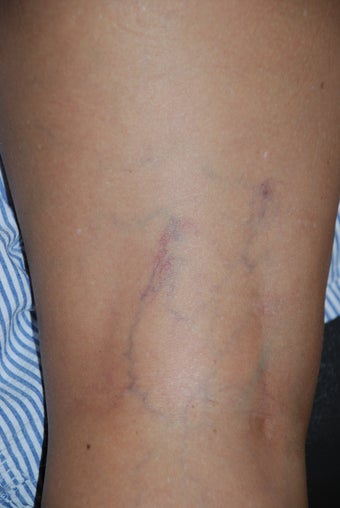 Sclerotherapy before 470090