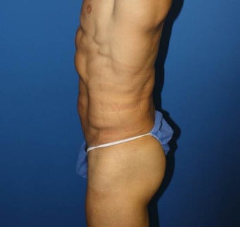 High-Definition Liposuction 402412