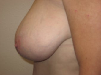 Breast Reduction before 291350
