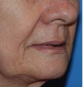 Fat Transfer / Fat Grafting / YoungVolumizer Procedure before 166182