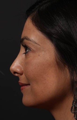 Facial fat grafting 514131