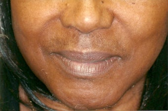 Restylane injection before 401308
