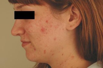 Laser Acne Treatment before 82945