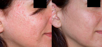 Dermabrasion before 306808