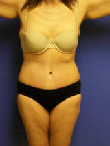 Extended Tummy Tuck Surgery after 136219