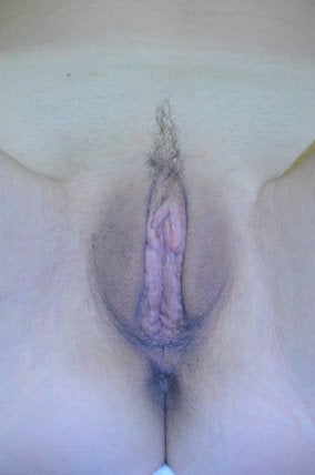 32 Year Old Female with Labial Hypertrophy 626761
