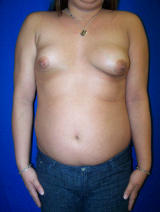 Constricted Breast Deformity before 136215