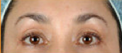 BOTOX after 284360