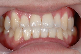 Invisalign Treatment before 356790