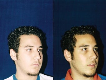 Rhinoplasty and Septoplasty before 241686