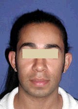 Otoplasty (Ear Surgery) before 146594