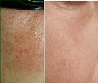 IPL for Age Spots before 6380