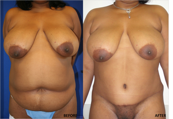 Abdominoplasty (tummy tuck), Flank Liposuction before 328417