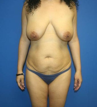 Tummy Tuck, Abdominoplasty, Liposuction, Breast Implants before 402489