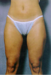 Suction Lipectormy of Inner and Outer thighs after 427988