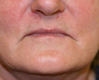 Lips before 299910