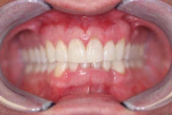 Invisalign after 372718