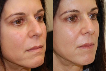 Lip Augmentation with Silikon-1000 before 407823