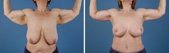 Arm lift (Brachioplasty) 303698