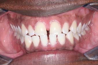 Invisalign before 372713