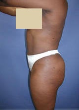 Body Contouring with Liposuction after 133795