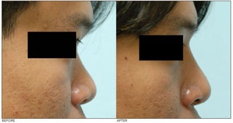Asian Rhinoplasty before 136819