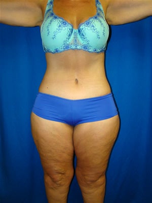 Extended Tummy Tuck Surgery after 139428