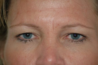 Forehead Lift before 434857
