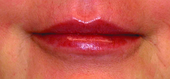Lip augmentation after 369093