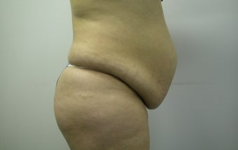 Abdominoplasty before 607511