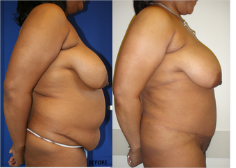 Abdominoplasty (tummy tuck), Flank Liposuction 328417