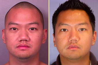 Rhinoplasty before 271199