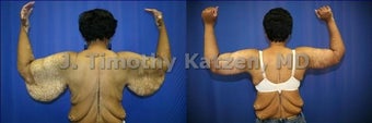Before and after picture arm lift arm reduction after massive weight loss gastric bypass female african american back view before 644257