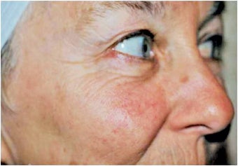 Deep/Active FX Laser Treatment before 282786