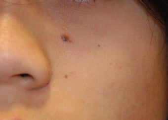Mole removal before 199338