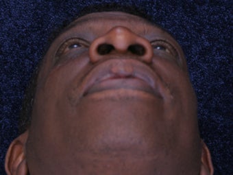 Rhinoplasty 396370