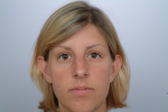 otoplasty before 358567