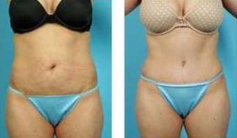 Tummy Tuck (Abdominoplasty) before 324843