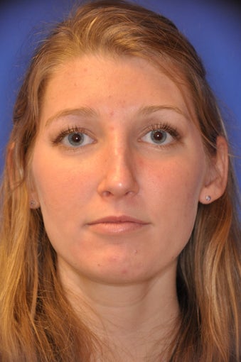 Revision Rhinoplasty 478750
