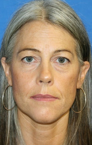 Upper and Lower Eye Lid Blepharoplasty with Fat Transfer before 250411